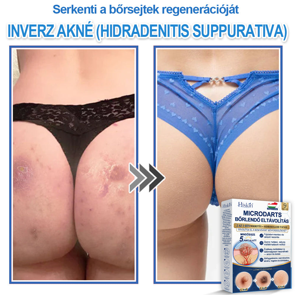 👩‍⚕️ 𝐇𝐢𝐬𝐤𝐢𝐧® 𝟐 𝐚𝐳 𝟏-𝐛𝐞𝐧 𝐌𝐢𝐤𝐫𝐨𝐭ű𝐬 & 𝐇𝐢𝐝𝐫𝐨𝐤𝐨𝐥𝐥𝐨𝐢𝐝 𝐓𝐚𝐩𝐚𝐬𝐳 | 𝐊𝐢𝐞𝐦𝐞𝐥𝐤𝐞𝐝ő 𝐚𝐧𝐲𝐚𝐣𝐞𝐠𝐲𝐞𝐤, 𝐚𝐤𝐧é, 𝐥𝐚𝐩𝐨𝐬 𝐬𝐳𝐞𝐦ö𝐥𝐜𝐬ö𝐤 é𝐬 𝐛ő𝐫𝐤𝐢𝐧ö𝐯é𝐬𝐞𝐤 𝐞𝐥𝐭á𝐯𝐨𝐥í𝐭á𝐬á𝐫𝐚 | 𝐒𝐞𝐠í𝐭 𝐣𝐚𝐯í𝐭𝐚𝐧𝐢 𝐚 𝐫á𝐧𝐜𝐨𝐤, 𝐡𝐞𝐠𝐞𝐤 é𝐬 𝐛ő𝐫𝐡𝐢𝐛á𝐤 𝐦𝐞𝐠𝐣𝐞𝐥𝐞𝐧é𝐬é𝐭 | 𝐋á𝐭𝐡𝐚𝐭𝐚𝐭𝐥𝐚𝐧 𝐜𝐬𝐢𝐥𝐥𝐚𝐠 𝐚𝐥𝐚𝐤ú 𝐩𝐚𝐭𝐭𝐚𝐧á𝐬𝐭𝐚𝐩𝐚𝐬𝐳 𝐚𝐫𝐜𝐫𝐚 é𝐬 𝐭𝐞𝐬𝐭𝐫𝐞