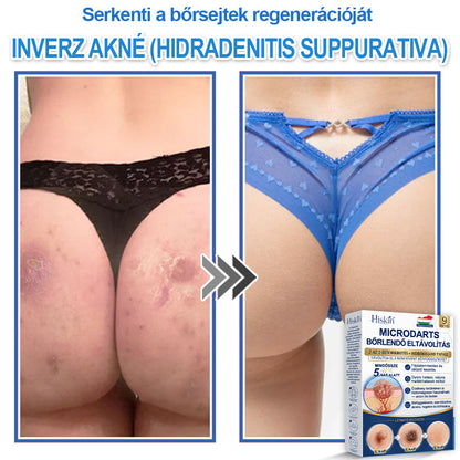 👩‍⚕️ 𝐇𝐢𝐬𝐤𝐢𝐧® 𝟐 𝐚𝐳 𝟏-𝐛𝐞𝐧 𝐌𝐢𝐤𝐫𝐨𝐭ű𝐬 & 𝐇𝐢𝐝𝐫𝐨𝐤𝐨𝐥𝐥𝐨𝐢𝐝 𝐓𝐚𝐩𝐚𝐬𝐳 | 𝐊𝐢𝐞𝐦𝐞𝐥𝐤𝐞𝐝ő 𝐚𝐧𝐲𝐚𝐣𝐞𝐠𝐲𝐞𝐤, 𝐚𝐤𝐧é, 𝐥𝐚𝐩𝐨𝐬 𝐬𝐳𝐞𝐦ö𝐥𝐜𝐬ö𝐤 é𝐬 𝐛ő𝐫𝐤𝐢𝐧ö𝐯é𝐬𝐞𝐤 𝐞𝐥𝐭á𝐯𝐨𝐥í𝐭á𝐬á𝐫𝐚 | 𝐒𝐞𝐠í𝐭 𝐣𝐚𝐯í𝐭𝐚𝐧𝐢 𝐚 𝐫á𝐧𝐜𝐨𝐤, 𝐡𝐞𝐠𝐞𝐤 é𝐬 𝐛ő𝐫𝐡𝐢𝐛á𝐤 𝐦𝐞𝐠𝐣𝐞𝐥𝐞𝐧é𝐬é𝐭 | 𝐋á𝐭𝐡𝐚𝐭𝐚𝐭𝐥𝐚𝐧 𝐜𝐬𝐢𝐥𝐥𝐚𝐠 𝐚𝐥𝐚𝐤ú 𝐩𝐚𝐭𝐭𝐚𝐧á𝐬𝐭𝐚𝐩𝐚𝐬𝐳 𝐚𝐫𝐜𝐫𝐚 é𝐬 𝐭𝐞𝐬𝐭𝐫𝐞