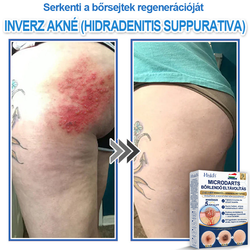 👩‍⚕️ 𝐇𝐢𝐬𝐤𝐢𝐧® 𝟐 𝐚𝐳 𝟏-𝐛𝐞𝐧 𝐌𝐢𝐤𝐫𝐨𝐭ű𝐬 & 𝐇𝐢𝐝𝐫𝐨𝐤𝐨𝐥𝐥𝐨𝐢𝐝 𝐓𝐚𝐩𝐚𝐬𝐳 | 𝐊𝐢𝐞𝐦𝐞𝐥𝐤𝐞𝐝ő 𝐚𝐧𝐲𝐚𝐣𝐞𝐠𝐲𝐞𝐤, 𝐚𝐤𝐧é, 𝐥𝐚𝐩𝐨𝐬 𝐬𝐳𝐞𝐦ö𝐥𝐜𝐬ö𝐤 é𝐬 𝐛ő𝐫𝐤𝐢𝐧ö𝐯é𝐬𝐞𝐤 𝐞𝐥𝐭á𝐯𝐨𝐥í𝐭á𝐬á𝐫𝐚 | 𝐒𝐞𝐠í𝐭 𝐣𝐚𝐯í𝐭𝐚𝐧𝐢 𝐚 𝐫á𝐧𝐜𝐨𝐤, 𝐡𝐞𝐠𝐞𝐤 é𝐬 𝐛ő𝐫𝐡𝐢𝐛á𝐤 𝐦𝐞𝐠𝐣𝐞𝐥𝐞𝐧é𝐬é𝐭 | 𝐋á𝐭𝐡𝐚𝐭𝐚𝐭𝐥𝐚𝐧 𝐜𝐬𝐢𝐥𝐥𝐚𝐠 𝐚𝐥𝐚𝐤ú 𝐩𝐚𝐭𝐭𝐚𝐧á𝐬𝐭𝐚𝐩𝐚𝐬𝐳 𝐚𝐫𝐜𝐫𝐚 é𝐬 𝐭𝐞𝐬𝐭𝐫𝐞