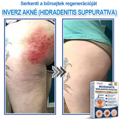 👩‍⚕️ 𝐇𝐢𝐬𝐤𝐢𝐧® 𝟐 𝐚𝐳 𝟏-𝐛𝐞𝐧 𝐌𝐢𝐤𝐫𝐨𝐭ű𝐬 & 𝐇𝐢𝐝𝐫𝐨𝐤𝐨𝐥𝐥𝐨𝐢𝐝 𝐓𝐚𝐩𝐚𝐬𝐳 | 𝐊𝐢𝐞𝐦𝐞𝐥𝐤𝐞𝐝ő 𝐚𝐧𝐲𝐚𝐣𝐞𝐠𝐲𝐞𝐤, 𝐚𝐤𝐧é, 𝐥𝐚𝐩𝐨𝐬 𝐬𝐳𝐞𝐦ö𝐥𝐜𝐬ö𝐤 é𝐬 𝐛ő𝐫𝐤𝐢𝐧ö𝐯é𝐬𝐞𝐤 𝐞𝐥𝐭á𝐯𝐨𝐥í𝐭á𝐬á𝐫𝐚 | 𝐒𝐞𝐠í𝐭 𝐣𝐚𝐯í𝐭𝐚𝐧𝐢 𝐚 𝐫á𝐧𝐜𝐨𝐤, 𝐡𝐞𝐠𝐞𝐤 é𝐬 𝐛ő𝐫𝐡𝐢𝐛á𝐤 𝐦𝐞𝐠𝐣𝐞𝐥𝐞𝐧é𝐬é𝐭 | 𝐋á𝐭𝐡𝐚𝐭𝐚𝐭𝐥𝐚𝐧 𝐜𝐬𝐢𝐥𝐥𝐚𝐠 𝐚𝐥𝐚𝐤ú 𝐩𝐚𝐭𝐭𝐚𝐧á𝐬𝐭𝐚𝐩𝐚𝐬𝐳 𝐚𝐫𝐜𝐫𝐚 é𝐬 𝐭𝐞𝐬𝐭𝐫𝐞