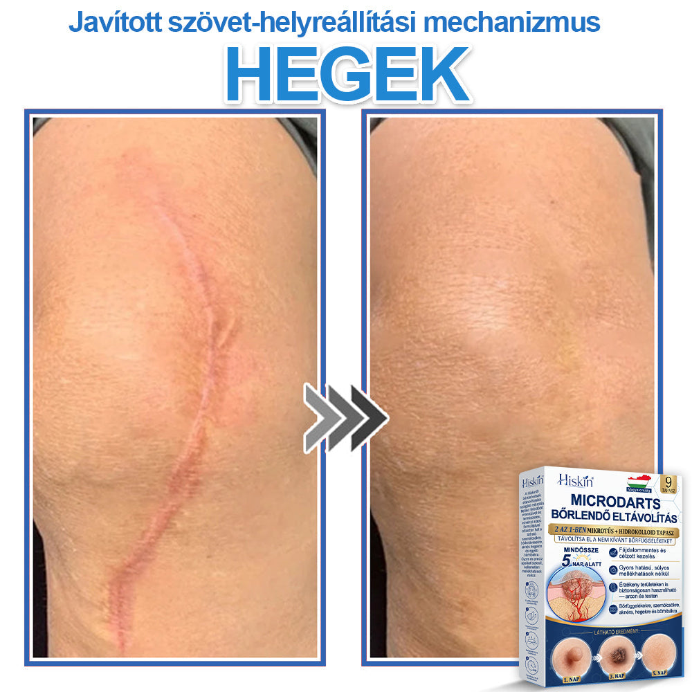 👩‍⚕️ 𝐇𝐢𝐬𝐤𝐢𝐧® 𝟐 𝐚𝐳 𝟏-𝐛𝐞𝐧 𝐌𝐢𝐤𝐫𝐨𝐭ű𝐬 & 𝐇𝐢𝐝𝐫𝐨𝐤𝐨𝐥𝐥𝐨𝐢𝐝 𝐓𝐚𝐩𝐚𝐬𝐳 | 𝐊𝐢𝐞𝐦𝐞𝐥𝐤𝐞𝐝ő 𝐚𝐧𝐲𝐚𝐣𝐞𝐠𝐲𝐞𝐤, 𝐚𝐤𝐧é, 𝐥𝐚𝐩𝐨𝐬 𝐬𝐳𝐞𝐦ö𝐥𝐜𝐬ö𝐤 é𝐬 𝐛ő𝐫𝐤𝐢𝐧ö𝐯é𝐬𝐞𝐤 𝐞𝐥𝐭á𝐯𝐨𝐥í𝐭á𝐬á𝐫𝐚 | 𝐒𝐞𝐠í𝐭 𝐣𝐚𝐯í𝐭𝐚𝐧𝐢 𝐚 𝐫á𝐧𝐜𝐨𝐤, 𝐡𝐞𝐠𝐞𝐤 é𝐬 𝐛ő𝐫𝐡𝐢𝐛á𝐤 𝐦𝐞𝐠𝐣𝐞𝐥𝐞𝐧é𝐬é𝐭 | 𝐋á𝐭𝐡𝐚𝐭𝐚𝐭𝐥𝐚𝐧 𝐜𝐬𝐢𝐥𝐥𝐚𝐠 𝐚𝐥𝐚𝐤ú 𝐩𝐚𝐭𝐭𝐚𝐧á𝐬𝐭𝐚𝐩𝐚𝐬𝐳 𝐚𝐫𝐜𝐫𝐚 é𝐬 𝐭𝐞𝐬𝐭𝐫𝐞