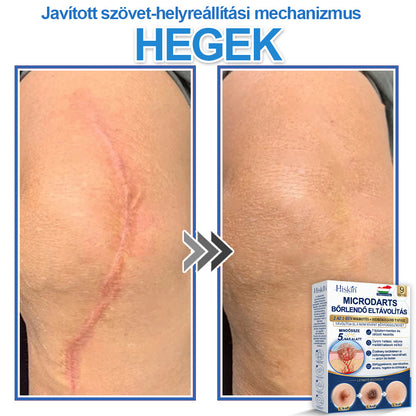 👩‍⚕️ 𝐇𝐢𝐬𝐤𝐢𝐧® 𝟐 𝐚𝐳 𝟏-𝐛𝐞𝐧 𝐌𝐢𝐤𝐫𝐨𝐭ű𝐬 & 𝐇𝐢𝐝𝐫𝐨𝐤𝐨𝐥𝐥𝐨𝐢𝐝 𝐓𝐚𝐩𝐚𝐬𝐳 | 𝐊𝐢𝐞𝐦𝐞𝐥𝐤𝐞𝐝ő 𝐚𝐧𝐲𝐚𝐣𝐞𝐠𝐲𝐞𝐤, 𝐚𝐤𝐧é, 𝐥𝐚𝐩𝐨𝐬 𝐬𝐳𝐞𝐦ö𝐥𝐜𝐬ö𝐤 é𝐬 𝐛ő𝐫𝐤𝐢𝐧ö𝐯é𝐬𝐞𝐤 𝐞𝐥𝐭á𝐯𝐨𝐥í𝐭á𝐬á𝐫𝐚 | 𝐒𝐞𝐠í𝐭 𝐣𝐚𝐯í𝐭𝐚𝐧𝐢 𝐚 𝐫á𝐧𝐜𝐨𝐤, 𝐡𝐞𝐠𝐞𝐤 é𝐬 𝐛ő𝐫𝐡𝐢𝐛á𝐤 𝐦𝐞𝐠𝐣𝐞𝐥𝐞𝐧é𝐬é𝐭 | 𝐋á𝐭𝐡𝐚𝐭𝐚𝐭𝐥𝐚𝐧 𝐜𝐬𝐢𝐥𝐥𝐚𝐠 𝐚𝐥𝐚𝐤ú 𝐩𝐚𝐭𝐭𝐚𝐧á𝐬𝐭𝐚𝐩𝐚𝐬𝐳 𝐚𝐫𝐜𝐫𝐚 é𝐬 𝐭𝐞𝐬𝐭𝐫𝐞