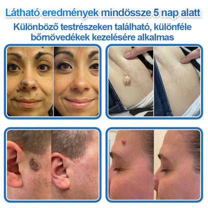 👩‍⚕️ 𝐇𝐢𝐬𝐤𝐢𝐧® 𝟐 𝐚𝐳 𝟏-𝐛𝐞𝐧 𝐌𝐢𝐤𝐫𝐨𝐭ű𝐬 & 𝐇𝐢𝐝𝐫𝐨𝐤𝐨𝐥𝐥𝐨𝐢𝐝 𝐓𝐚𝐩𝐚𝐬𝐳 | 𝐊𝐢𝐞𝐦𝐞𝐥𝐤𝐞𝐝ő 𝐚𝐧𝐲𝐚𝐣𝐞𝐠𝐲𝐞𝐤, 𝐚𝐤𝐧é, 𝐥𝐚𝐩𝐨𝐬 𝐬𝐳𝐞𝐦ö𝐥𝐜𝐬ö𝐤 é𝐬 𝐛ő𝐫𝐤𝐢𝐧ö𝐯é𝐬𝐞𝐤 𝐞𝐥𝐭á𝐯𝐨𝐥í𝐭á𝐬á𝐫𝐚 | 𝐒𝐞𝐠í𝐭 𝐣𝐚𝐯í𝐭𝐚𝐧𝐢 𝐚 𝐫á𝐧𝐜𝐨𝐤, 𝐡𝐞𝐠𝐞𝐤 é𝐬 𝐛ő𝐫𝐡𝐢𝐛á𝐤 𝐦𝐞𝐠𝐣𝐞𝐥𝐞𝐧é𝐬é𝐭 | 𝐋á𝐭𝐡𝐚𝐭𝐚𝐭𝐥𝐚𝐧 𝐜𝐬𝐢𝐥𝐥𝐚𝐠 𝐚𝐥𝐚𝐤ú 𝐩𝐚𝐭𝐭𝐚𝐧á𝐬𝐭𝐚𝐩𝐚𝐬𝐳 𝐚𝐫𝐜𝐫𝐚 é𝐬 𝐭𝐞𝐬𝐭𝐫𝐞