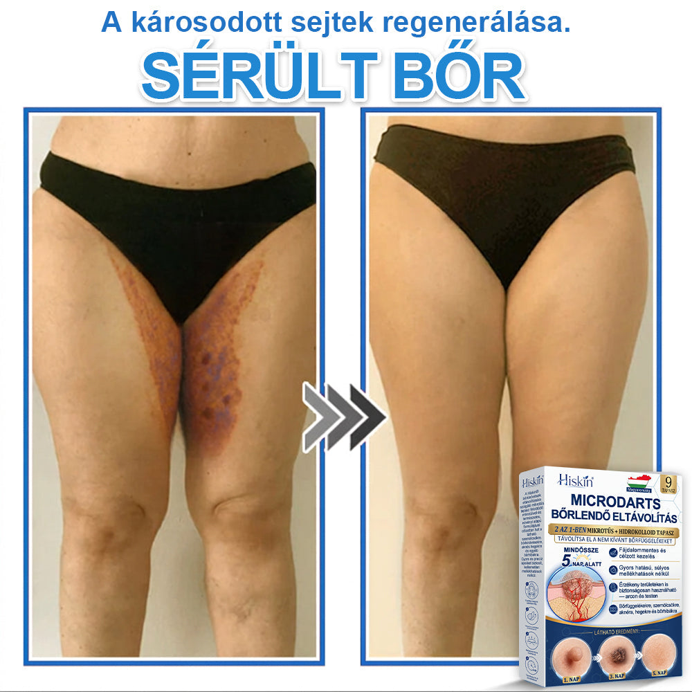 👩‍⚕️ 𝐇𝐢𝐬𝐤𝐢𝐧® 𝟐 𝐚𝐳 𝟏-𝐛𝐞𝐧 𝐌𝐢𝐤𝐫𝐨𝐭ű𝐬 & 𝐇𝐢𝐝𝐫𝐨𝐤𝐨𝐥𝐥𝐨𝐢𝐝 𝐓𝐚𝐩𝐚𝐬𝐳 | 𝐊𝐢𝐞𝐦𝐞𝐥𝐤𝐞𝐝ő 𝐚𝐧𝐲𝐚𝐣𝐞𝐠𝐲𝐞𝐤, 𝐚𝐤𝐧é, 𝐥𝐚𝐩𝐨𝐬 𝐬𝐳𝐞𝐦ö𝐥𝐜𝐬ö𝐤 é𝐬 𝐛ő𝐫𝐤𝐢𝐧ö𝐯é𝐬𝐞𝐤 𝐞𝐥𝐭á𝐯𝐨𝐥í𝐭á𝐬á𝐫𝐚 | 𝐒𝐞𝐠í𝐭 𝐣𝐚𝐯í𝐭𝐚𝐧𝐢 𝐚 𝐫á𝐧𝐜𝐨𝐤, 𝐡𝐞𝐠𝐞𝐤 é𝐬 𝐛ő𝐫𝐡𝐢𝐛á𝐤 𝐦𝐞𝐠𝐣𝐞𝐥𝐞𝐧é𝐬é𝐭 | 𝐋á𝐭𝐡𝐚𝐭𝐚𝐭𝐥𝐚𝐧 𝐜𝐬𝐢𝐥𝐥𝐚𝐠 𝐚𝐥𝐚𝐤ú 𝐩𝐚𝐭𝐭𝐚𝐧á𝐬𝐭𝐚𝐩𝐚𝐬𝐳 𝐚𝐫𝐜𝐫𝐚 é𝐬 𝐭𝐞𝐬𝐭𝐫𝐞