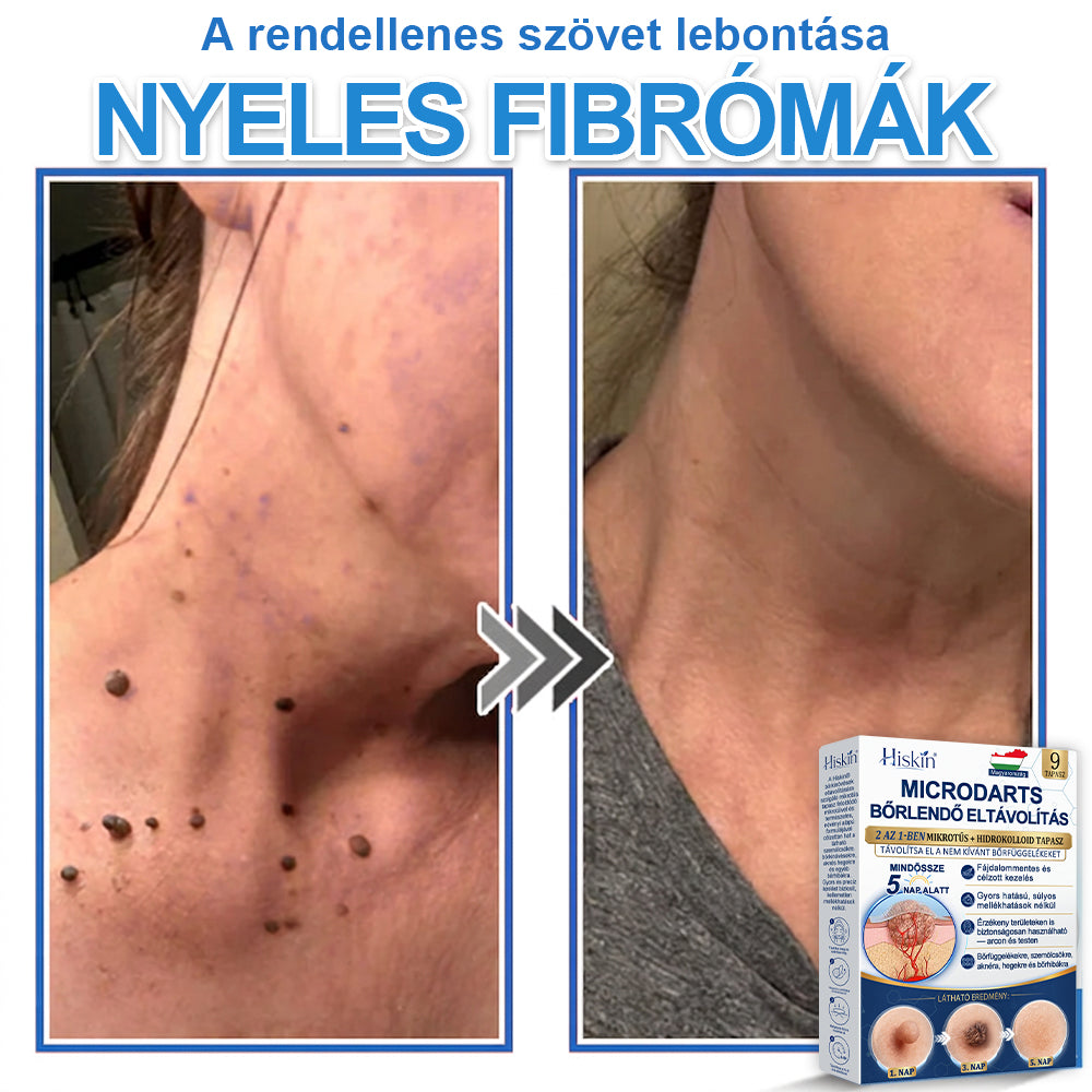 👩‍⚕️ 𝐇𝐢𝐬𝐤𝐢𝐧® 𝟐 𝐚𝐳 𝟏-𝐛𝐞𝐧 𝐌𝐢𝐤𝐫𝐨𝐭ű𝐬 & 𝐇𝐢𝐝𝐫𝐨𝐤𝐨𝐥𝐥𝐨𝐢𝐝 𝐓𝐚𝐩𝐚𝐬𝐳 | 𝐊𝐢𝐞𝐦𝐞𝐥𝐤𝐞𝐝ő 𝐚𝐧𝐲𝐚𝐣𝐞𝐠𝐲𝐞𝐤, 𝐚𝐤𝐧é, 𝐥𝐚𝐩𝐨𝐬 𝐬𝐳𝐞𝐦ö𝐥𝐜𝐬ö𝐤 é𝐬 𝐛ő𝐫𝐤𝐢𝐧ö𝐯é𝐬𝐞𝐤 𝐞𝐥𝐭á𝐯𝐨𝐥í𝐭á𝐬á𝐫𝐚 | 𝐒𝐞𝐠í𝐭 𝐣𝐚𝐯í𝐭𝐚𝐧𝐢 𝐚 𝐫á𝐧𝐜𝐨𝐤, 𝐡𝐞𝐠𝐞𝐤 é𝐬 𝐛ő𝐫𝐡𝐢𝐛á𝐤 𝐦𝐞𝐠𝐣𝐞𝐥𝐞𝐧é𝐬é𝐭 | 𝐋á𝐭𝐡𝐚𝐭𝐚𝐭𝐥𝐚𝐧 𝐜𝐬𝐢𝐥𝐥𝐚𝐠 𝐚𝐥𝐚𝐤ú 𝐩𝐚𝐭𝐭𝐚𝐧á𝐬𝐭𝐚𝐩𝐚𝐬𝐳 𝐚𝐫𝐜𝐫𝐚 é𝐬 𝐭𝐞𝐬𝐭𝐫𝐞