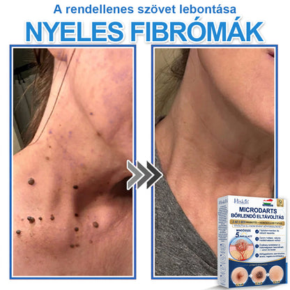 👩‍⚕️ 𝐇𝐢𝐬𝐤𝐢𝐧® 𝟐 𝐚𝐳 𝟏-𝐛𝐞𝐧 𝐌𝐢𝐤𝐫𝐨𝐭ű𝐬 & 𝐇𝐢𝐝𝐫𝐨𝐤𝐨𝐥𝐥𝐨𝐢𝐝 𝐓𝐚𝐩𝐚𝐬𝐳 | 𝐊𝐢𝐞𝐦𝐞𝐥𝐤𝐞𝐝ő 𝐚𝐧𝐲𝐚𝐣𝐞𝐠𝐲𝐞𝐤, 𝐚𝐤𝐧é, 𝐥𝐚𝐩𝐨𝐬 𝐬𝐳𝐞𝐦ö𝐥𝐜𝐬ö𝐤 é𝐬 𝐛ő𝐫𝐤𝐢𝐧ö𝐯é𝐬𝐞𝐤 𝐞𝐥𝐭á𝐯𝐨𝐥í𝐭á𝐬á𝐫𝐚 | 𝐒𝐞𝐠í𝐭 𝐣𝐚𝐯í𝐭𝐚𝐧𝐢 𝐚 𝐫á𝐧𝐜𝐨𝐤, 𝐡𝐞𝐠𝐞𝐤 é𝐬 𝐛ő𝐫𝐡𝐢𝐛á𝐤 𝐦𝐞𝐠𝐣𝐞𝐥𝐞𝐧é𝐬é𝐭 | 𝐋á𝐭𝐡𝐚𝐭𝐚𝐭𝐥𝐚𝐧 𝐜𝐬𝐢𝐥𝐥𝐚𝐠 𝐚𝐥𝐚𝐤ú 𝐩𝐚𝐭𝐭𝐚𝐧á𝐬𝐭𝐚𝐩𝐚𝐬𝐳 𝐚𝐫𝐜𝐫𝐚 é𝐬 𝐭𝐞𝐬𝐭𝐫𝐞