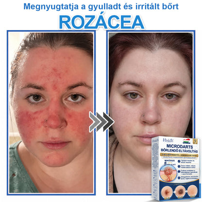 👩‍⚕️ 𝐇𝐢𝐬𝐤𝐢𝐧® 𝟐 𝐚𝐳 𝟏-𝐛𝐞𝐧 𝐌𝐢𝐤𝐫𝐨𝐭ű𝐬 & 𝐇𝐢𝐝𝐫𝐨𝐤𝐨𝐥𝐥𝐨𝐢𝐝 𝐓𝐚𝐩𝐚𝐬𝐳 | 𝐊𝐢𝐞𝐦𝐞𝐥𝐤𝐞𝐝ő 𝐚𝐧𝐲𝐚𝐣𝐞𝐠𝐲𝐞𝐤, 𝐚𝐤𝐧é, 𝐥𝐚𝐩𝐨𝐬 𝐬𝐳𝐞𝐦ö𝐥𝐜𝐬ö𝐤 é𝐬 𝐛ő𝐫𝐤𝐢𝐧ö𝐯é𝐬𝐞𝐤 𝐞𝐥𝐭á𝐯𝐨𝐥í𝐭á𝐬á𝐫𝐚 | 𝐒𝐞𝐠í𝐭 𝐣𝐚𝐯í𝐭𝐚𝐧𝐢 𝐚 𝐫á𝐧𝐜𝐨𝐤, 𝐡𝐞𝐠𝐞𝐤 é𝐬 𝐛ő𝐫𝐡𝐢𝐛á𝐤 𝐦𝐞𝐠𝐣𝐞𝐥𝐞𝐧é𝐬é𝐭 | 𝐋á𝐭𝐡𝐚𝐭𝐚𝐭𝐥𝐚𝐧 𝐜𝐬𝐢𝐥𝐥𝐚𝐠 𝐚𝐥𝐚𝐤ú 𝐩𝐚𝐭𝐭𝐚𝐧á𝐬𝐭𝐚𝐩𝐚𝐬𝐳 𝐚𝐫𝐜𝐫𝐚 é𝐬 𝐭𝐞𝐬𝐭𝐫𝐞
