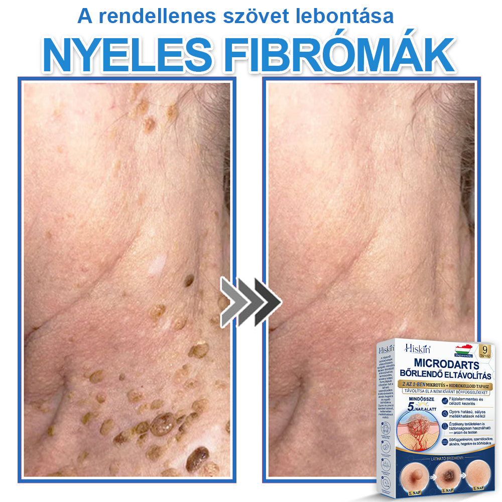 👩‍⚕️ 𝐇𝐢𝐬𝐤𝐢𝐧® 𝟐 𝐚𝐳 𝟏-𝐛𝐞𝐧 𝐌𝐢𝐤𝐫𝐨𝐭ű𝐬 & 𝐇𝐢𝐝𝐫𝐨𝐤𝐨𝐥𝐥𝐨𝐢𝐝 𝐓𝐚𝐩𝐚𝐬𝐳 | 𝐊𝐢𝐞𝐦𝐞𝐥𝐤𝐞𝐝ő 𝐚𝐧𝐲𝐚𝐣𝐞𝐠𝐲𝐞𝐤, 𝐚𝐤𝐧é, 𝐥𝐚𝐩𝐨𝐬 𝐬𝐳𝐞𝐦ö𝐥𝐜𝐬ö𝐤 é𝐬 𝐛ő𝐫𝐤𝐢𝐧ö𝐯é𝐬𝐞𝐤 𝐞𝐥𝐭á𝐯𝐨𝐥í𝐭á𝐬á𝐫𝐚 | 𝐒𝐞𝐠í𝐭 𝐣𝐚𝐯í𝐭𝐚𝐧𝐢 𝐚 𝐫á𝐧𝐜𝐨𝐤, 𝐡𝐞𝐠𝐞𝐤 é𝐬 𝐛ő𝐫𝐡𝐢𝐛á𝐤 𝐦𝐞𝐠𝐣𝐞𝐥𝐞𝐧é𝐬é𝐭 | 𝐋á𝐭𝐡𝐚𝐭𝐚𝐭𝐥𝐚𝐧 𝐜𝐬𝐢𝐥𝐥𝐚𝐠 𝐚𝐥𝐚𝐤ú 𝐩𝐚𝐭𝐭𝐚𝐧á𝐬𝐭𝐚𝐩𝐚𝐬𝐳 𝐚𝐫𝐜𝐫𝐚 é𝐬 𝐭𝐞𝐬𝐭𝐫𝐞