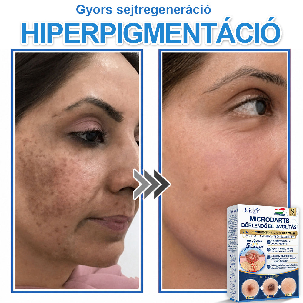 👩‍⚕️ 𝐇𝐢𝐬𝐤𝐢𝐧® 𝟐 𝐚𝐳 𝟏-𝐛𝐞𝐧 𝐌𝐢𝐤𝐫𝐨𝐭ű𝐬 & 𝐇𝐢𝐝𝐫𝐨𝐤𝐨𝐥𝐥𝐨𝐢𝐝 𝐓𝐚𝐩𝐚𝐬𝐳 | 𝐊𝐢𝐞𝐦𝐞𝐥𝐤𝐞𝐝ő 𝐚𝐧𝐲𝐚𝐣𝐞𝐠𝐲𝐞𝐤, 𝐚𝐤𝐧é, 𝐥𝐚𝐩𝐨𝐬 𝐬𝐳𝐞𝐦ö𝐥𝐜𝐬ö𝐤 é𝐬 𝐛ő𝐫𝐤𝐢𝐧ö𝐯é𝐬𝐞𝐤 𝐞𝐥𝐭á𝐯𝐨𝐥í𝐭á𝐬á𝐫𝐚 | 𝐒𝐞𝐠í𝐭 𝐣𝐚𝐯í𝐭𝐚𝐧𝐢 𝐚 𝐫á𝐧𝐜𝐨𝐤, 𝐡𝐞𝐠𝐞𝐤 é𝐬 𝐛ő𝐫𝐡𝐢𝐛á𝐤 𝐦𝐞𝐠𝐣𝐞𝐥𝐞𝐧é𝐬é𝐭 | 𝐋á𝐭𝐡𝐚𝐭𝐚𝐭𝐥𝐚𝐧 𝐜𝐬𝐢𝐥𝐥𝐚𝐠 𝐚𝐥𝐚𝐤ú 𝐩𝐚𝐭𝐭𝐚𝐧á𝐬𝐭𝐚𝐩𝐚𝐬𝐳 𝐚𝐫𝐜𝐫𝐚 é𝐬 𝐭𝐞𝐬𝐭𝐫𝐞