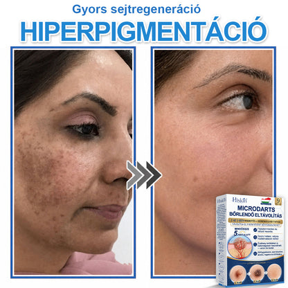 👩‍⚕️ 𝐇𝐢𝐬𝐤𝐢𝐧® 𝟐 𝐚𝐳 𝟏-𝐛𝐞𝐧 𝐌𝐢𝐤𝐫𝐨𝐭ű𝐬 & 𝐇𝐢𝐝𝐫𝐨𝐤𝐨𝐥𝐥𝐨𝐢𝐝 𝐓𝐚𝐩𝐚𝐬𝐳 | 𝐊𝐢𝐞𝐦𝐞𝐥𝐤𝐞𝐝ő 𝐚𝐧𝐲𝐚𝐣𝐞𝐠𝐲𝐞𝐤, 𝐚𝐤𝐧é, 𝐥𝐚𝐩𝐨𝐬 𝐬𝐳𝐞𝐦ö𝐥𝐜𝐬ö𝐤 é𝐬 𝐛ő𝐫𝐤𝐢𝐧ö𝐯é𝐬𝐞𝐤 𝐞𝐥𝐭á𝐯𝐨𝐥í𝐭á𝐬á𝐫𝐚 | 𝐒𝐞𝐠í𝐭 𝐣𝐚𝐯í𝐭𝐚𝐧𝐢 𝐚 𝐫á𝐧𝐜𝐨𝐤, 𝐡𝐞𝐠𝐞𝐤 é𝐬 𝐛ő𝐫𝐡𝐢𝐛á𝐤 𝐦𝐞𝐠𝐣𝐞𝐥𝐞𝐧é𝐬é𝐭 | 𝐋á𝐭𝐡𝐚𝐭𝐚𝐭𝐥𝐚𝐧 𝐜𝐬𝐢𝐥𝐥𝐚𝐠 𝐚𝐥𝐚𝐤ú 𝐩𝐚𝐭𝐭𝐚𝐧á𝐬𝐭𝐚𝐩𝐚𝐬𝐳 𝐚𝐫𝐜𝐫𝐚 é𝐬 𝐭𝐞𝐬𝐭𝐫𝐞