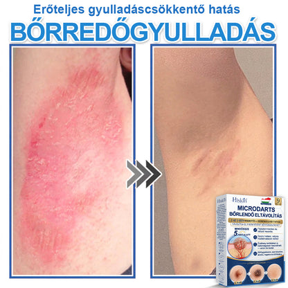 👩‍⚕️ 𝐇𝐢𝐬𝐤𝐢𝐧® 𝟐 𝐚𝐳 𝟏-𝐛𝐞𝐧 𝐌𝐢𝐤𝐫𝐨𝐭ű𝐬 & 𝐇𝐢𝐝𝐫𝐨𝐤𝐨𝐥𝐥𝐨𝐢𝐝 𝐓𝐚𝐩𝐚𝐬𝐳 | 𝐊𝐢𝐞𝐦𝐞𝐥𝐤𝐞𝐝ő 𝐚𝐧𝐲𝐚𝐣𝐞𝐠𝐲𝐞𝐤, 𝐚𝐤𝐧é, 𝐥𝐚𝐩𝐨𝐬 𝐬𝐳𝐞𝐦ö𝐥𝐜𝐬ö𝐤 é𝐬 𝐛ő𝐫𝐤𝐢𝐧ö𝐯é𝐬𝐞𝐤 𝐞𝐥𝐭á𝐯𝐨𝐥í𝐭á𝐬á𝐫𝐚 | 𝐒𝐞𝐠í𝐭 𝐣𝐚𝐯í𝐭𝐚𝐧𝐢 𝐚 𝐫á𝐧𝐜𝐨𝐤, 𝐡𝐞𝐠𝐞𝐤 é𝐬 𝐛ő𝐫𝐡𝐢𝐛á𝐤 𝐦𝐞𝐠𝐣𝐞𝐥𝐞𝐧é𝐬é𝐭 | 𝐋á𝐭𝐡𝐚𝐭𝐚𝐭𝐥𝐚𝐧 𝐜𝐬𝐢𝐥𝐥𝐚𝐠 𝐚𝐥𝐚𝐤ú 𝐩𝐚𝐭𝐭𝐚𝐧á𝐬𝐭𝐚𝐩𝐚𝐬𝐳 𝐚𝐫𝐜𝐫𝐚 é𝐬 𝐭𝐞𝐬𝐭𝐫𝐞